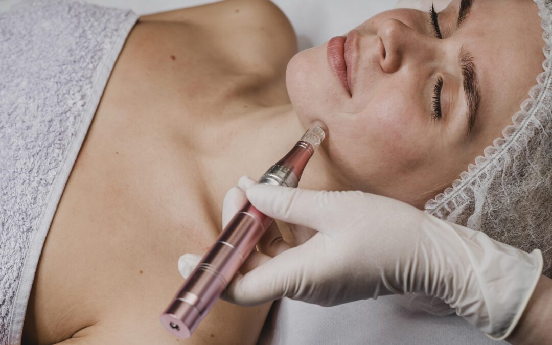 foto de una mujer a la que le están realizando microneedling tratamiento que mejora la piel